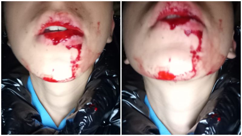 copil batut, bistrita, caz socant