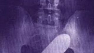 Un spital din Toulouse, evacuat din cauza unui obuz&nbsp;