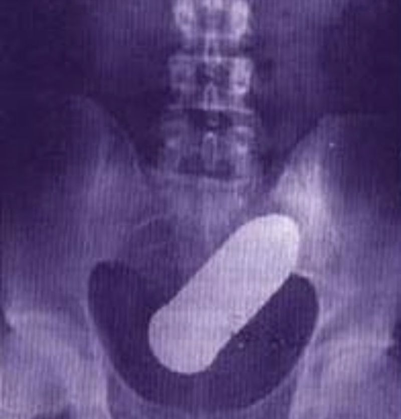 Un spital din Toulouse, evacuat din cauza unui obuz 