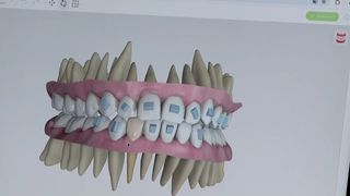 VIDEO Tehnologia și inteligența artificială revoluționează fațetele dentare