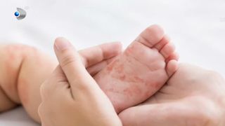 VIDEO Jumătate dintre copii nu sunt vaccinați &icirc;mpotriva rujeolei