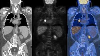 Studiu revoluționar: senzori subțiri ca firul de păr pot detecta apariția cancerului &icirc;n timp real