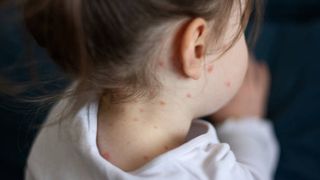 Epidemia de rujeolă face victime. Aproape 100 de persoane au murit &icirc;n Bangladesh