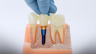 (P) C&acirc;nd alegerea coroanei dentare trebuie făcută după criterii reale, nu doar după denumirea materialului