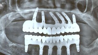 VIDEO &bdquo;Sănătatea orală poate fi afectată&rdquo;. Cum să vă &icirc;ngrijiți dantura la menopauză