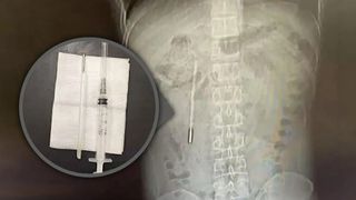 A ajuns la spital cu dureri puternice de stomac, dar medicii au găsit &icirc;n corpul său ceva șocant: un termometru &icirc;nghițit cu 20 de ani &icirc;n urmă