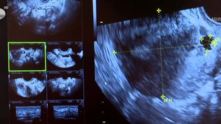 VIDEO Congelarea ovulelor, alegerea femeii moderne