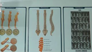 VIDEO &bdquo;Am probleme la mers&rdquo;. Osteoporoza, o boală tăcută