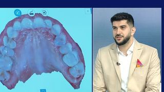 C&acirc;nd este necesar un implant dentar