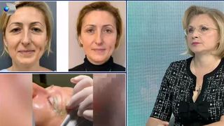 VIDEO Blefaroplastia, soluția pentru pleoape căzute