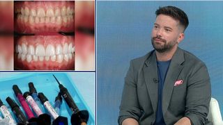 VIDEO &bdquo;Ar trebui să vedem exact c&acirc;nd avem nevoie&rdquo;. Totul despre fațetele dentare
