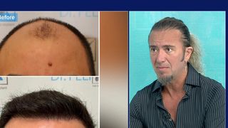VIDEO Transplantul de păr, fără tăieturi, fără urme