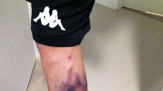 Piciorul i s-a inbastrit de la trening. Sursa foto: tolo.ro