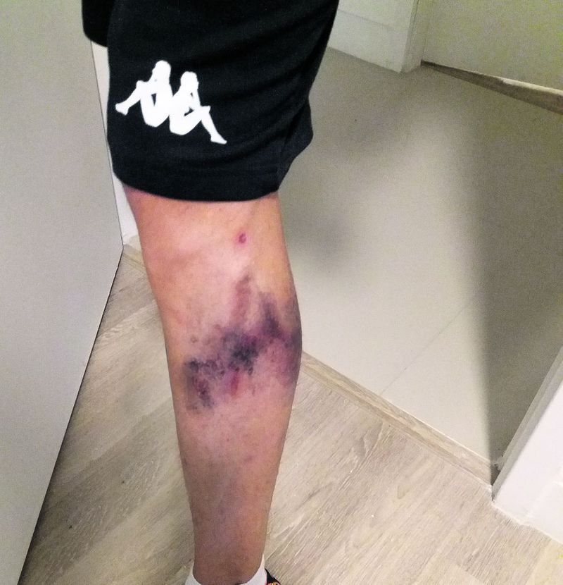 Piciorul i s-a inbastrit de la trening. Sursa foto: tolo.ro