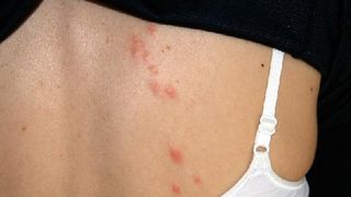 Parcul milionarilor din Bucuresti, invadat de purici! Parintii care si-au adus copiii in parcul Bordei acuza ca s-au infestat si nu mai pot sa scape de agresivele insecte