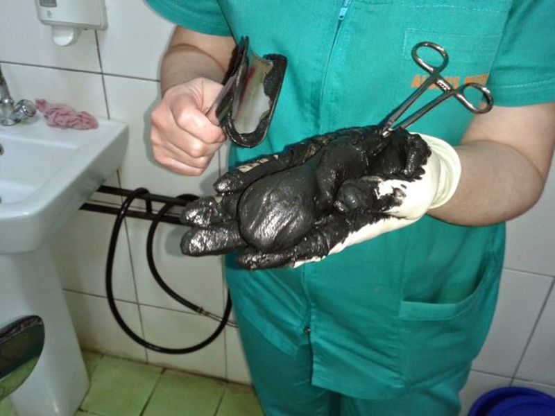 Tampon vaginal cu namol. Foto tratamentsovata.blogspot.ro