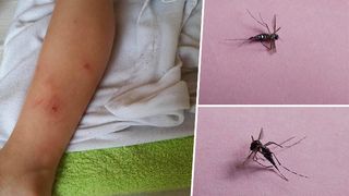 Asa arata picioarele unui copil din Bucuresti care a fost intepat de tantarul-tigru. Parintii sunt revoltati: "Ministerul Sanatatii ce face?"