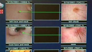 Semnele grave care ar trebui sa te trimita la doctor de urgenta! Daca le ai, inseamna ca esti suspect de cancer de piele