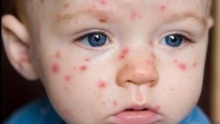 Epidemia de rujeola. Alte 23 de cazuri au fost confirmate &icirc;n ultima săptăm&acirc;nă. Numărul cazurilor ajunge la 753