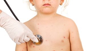 Ministrul Sanatatii recomanda vaccinarea urgenta a copiilor, dupa ce au fost inregistrate alte 33 de cazuri de rujeola, in ultima saptamana