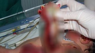 Asa arata Alex in urma cu sapte ani, dupa ce a fost ars in incubator
