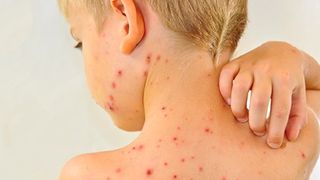 Arad. Un baiat de 15 ani, care avea rujeola, a murit