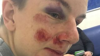 Cum a ajuns acest baiat autist sa arate in halul asta. A fost batut crunt si jefuit de mai multi tineri - Suma pentru care a incasat o bataie "sora cu moartea"