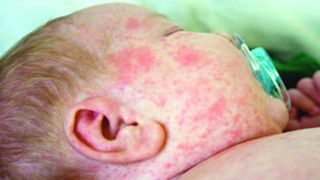 Epidemie de rujeola in Timis. 30 de copii au ajuns la urgente