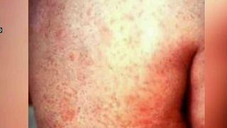 Vestul tarii este in carantina! Medicii au declarat epidemie de rujeola.