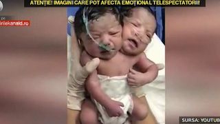 Bebelusul cu doua capete. S-a nascut la inceputul acestui an in Mexic