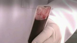 Doi morti si sase pacienti internati la Terapie Intensiva dupa transfuzii de sange la un spital din Craiova. Ce s-a intamplat