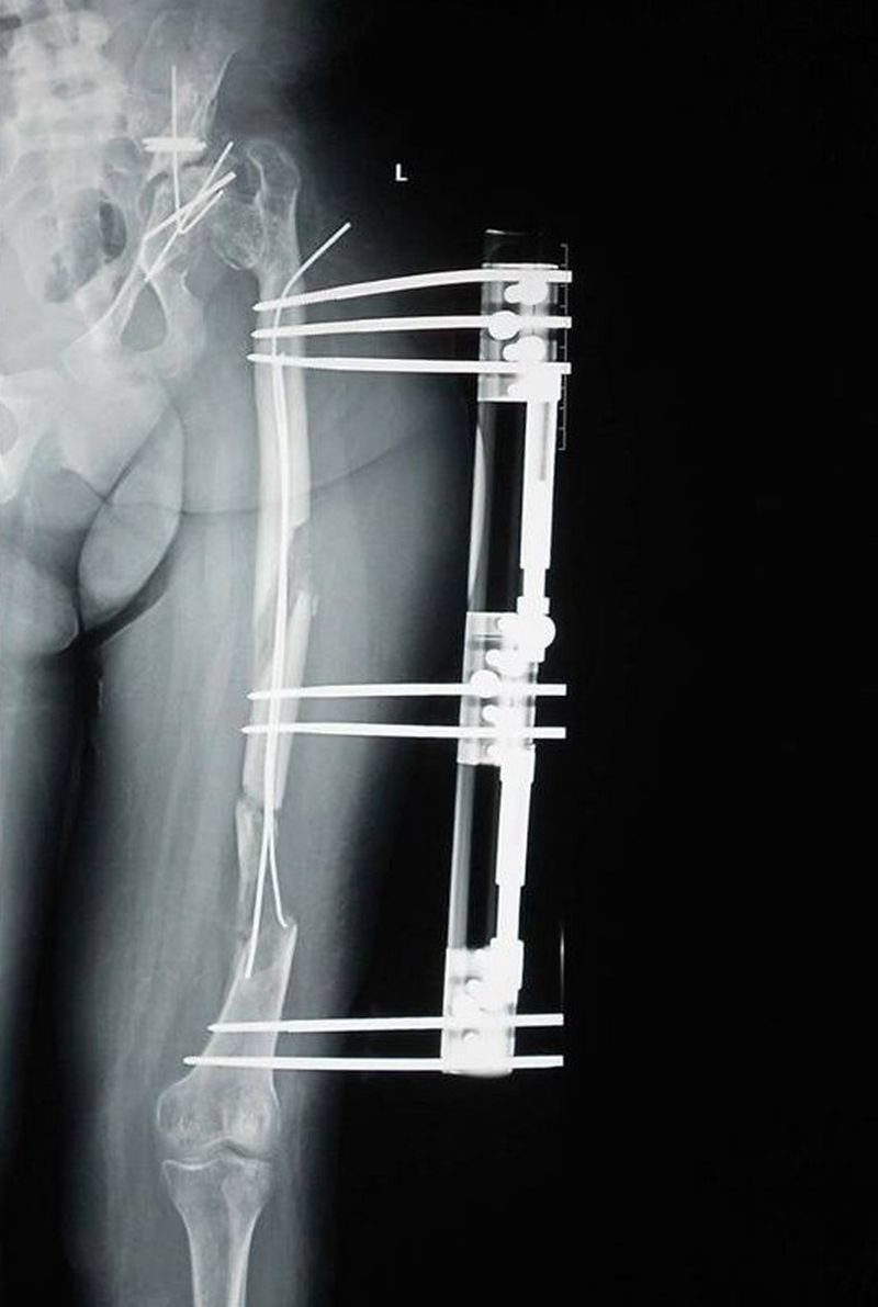 Asa arata fixatorul folosit de Burnei