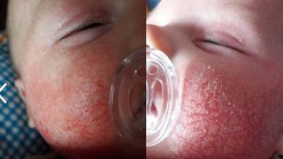 Un bebelus roman a fost tratat de doctorii englezi cu creme desi ii sangera fata