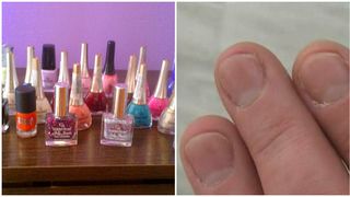 Urla de durere ori de cate ori apa calda ii ajunge pe degete. O tanara a ramas fara unghii dupa ce si-a facut manichiura cu gel