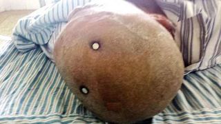 A ajuns la Urgente la spitalul din Timisoara cu doua cuie infipte in cap! Cum a fost posibil asa ceva?