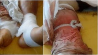 Imagini ingrozitoare. O pacienta a fost lasata cu pansamentele neschimbate zile la rand