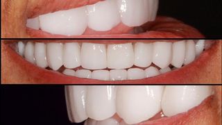 Statistica ingrijoratoare. Trei din zece romani nu mai au niciun dinte natural