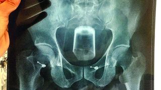 "E aici de doua zile! Nu mai pot, se umfla!" Un barbat a ajuns la spital cu dureri crunte dupa ce si-a bagat un pahar in anus