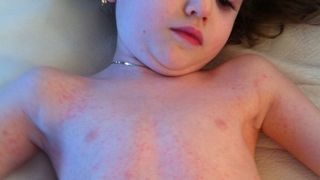 Al 34-lea deces din cauza rujeolei - un baietel cu anemie, in varsta de 5 luni. Peste 9.100 de cazuri in aproape un an de la declansarea epidemiei