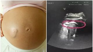 Femeie insarcinata, la un pas de moarte dupa ce bebelusul nenascut a lovit-o atat de tare incat i-a spart pantecul