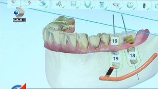 In tara in care unul din 3 romani are dinti lipsa, stomatologia a ajuns un fel de "joaca" pe calculator. Uite cat de usor capeti un zambet de revista