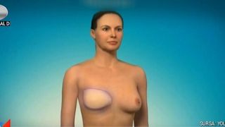 Medicii oncologi trag un semnal de alarma: din 8.000 de femei operate de cancer la san, doar 200 decid sa isi faca reconstructie