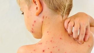 Un nou deces din cauza rujeolei. De la debutul epidemiei s-au inregistrat 35 de decese. Numarul imbolnavirilor a ajuns la 9.670