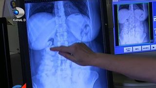 Autoritatile de pe Otopeni au ramas fara cuvinte! Ce se afla in stomacul unei femei care venea din Brazilia?! In viata lor n-au vazut asa ceva!