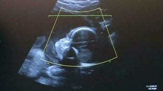 Suntem campioni europeni la nasteri prin cezariana! Chiar daca nu este indicata, medicii incurajeaza aceasta metoda pentru ca pot obtine mai multi bani!