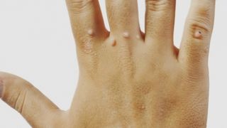 De ce apar negii. Cum poti sa previi sau sa tratezi aceasta problema