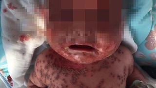 Greseala aproape fatala a unei mame! Si-a umplut copilul de rani dupa ce l-a pupat! Cum a fost posibil!