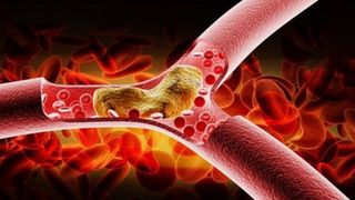 Ceaiuri pentru colesterol marit! Foloseste-te de plantele astea pentru a-ti reduce nivelul colesterolului!