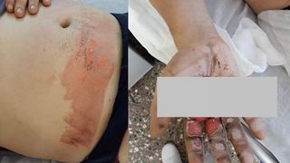 Incredibil! Unui tanar i-a explodat bateria de la tigara electronica, dupa care s-a intamplat ASTA! Mare atentie daca si tu folosesti!