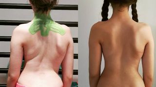 Miracol pentru fetita din Ploiesti care merge la scoala in pat pliant! Coloana ei a inceput sa se indrepte! Cum arata acum